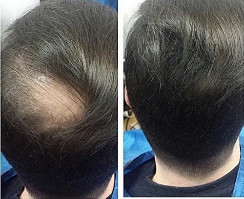 Traitement de perte de cheveux 100% de fibres de kératine
